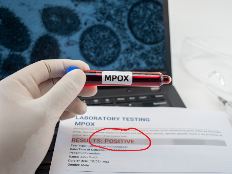 Blutprobe Mpox-Virus positiv