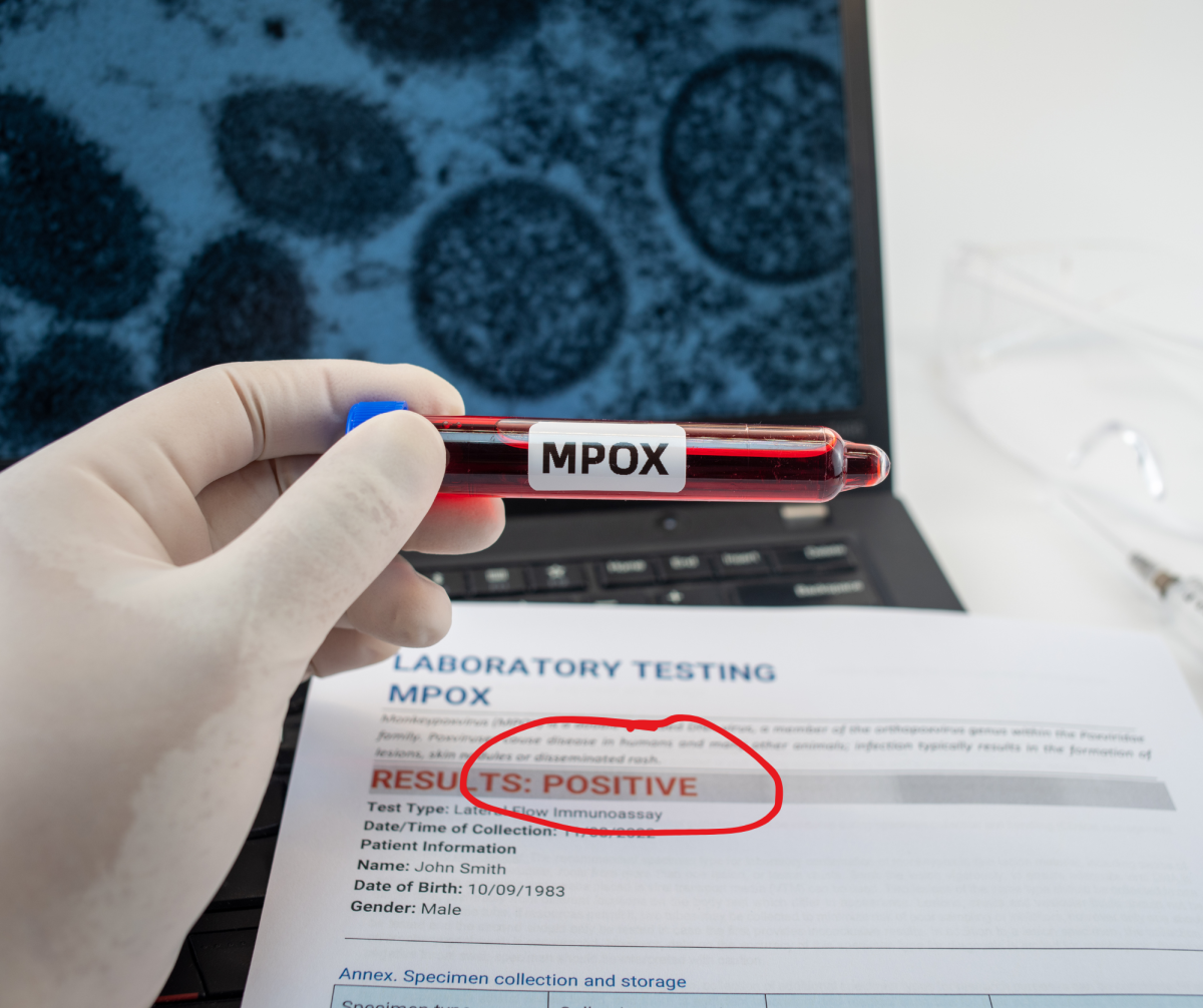 Blutprobe Mpox-Virus positiv